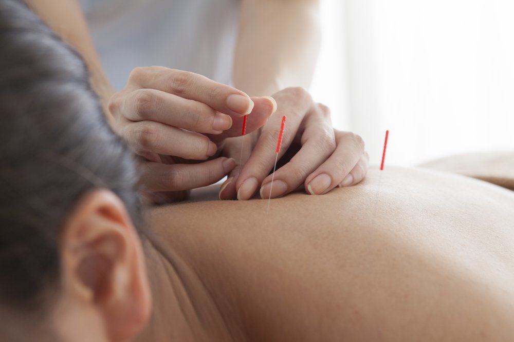 3 Jenis Efek Samping Terapi Akupuntur